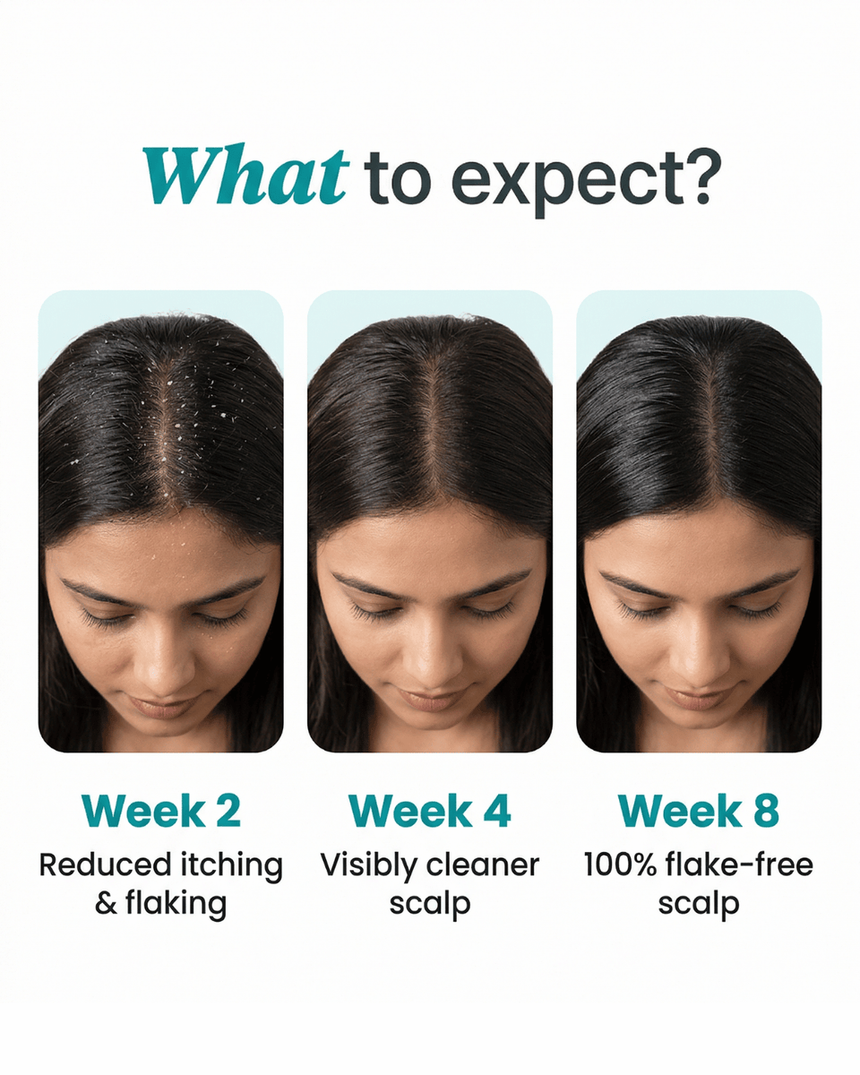 Anti-Dandruff Scalp Treatment - 50 ML