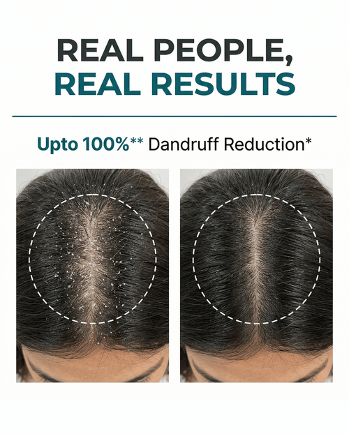 Anti-Dandruff Shampoo - 150 ML