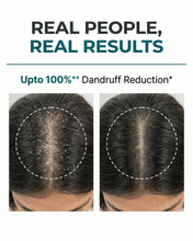 Load image into Gallery viewer, Anti-Dandruff Scalp Treatment - 50 ML